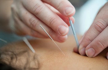 Akupunktur kan hjelpe mot kronisk tretthet